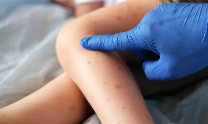 Secretaria Municipal de Saúde reforça alerta sobre risco de reintrodução do sarampo no país