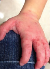 Educação e Saúde monitoram casos de mão-pé-boca no Estado