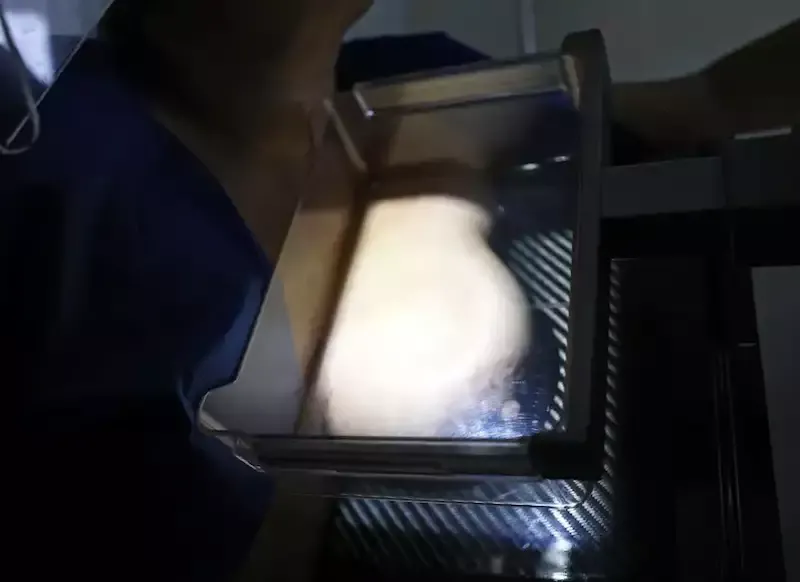 ANS quer limitar exames de mamografia e lobby dos planos de saúde agradece